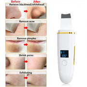 Ultrasonic Skin Scrubber Remover Blackhead Ultrasonic Peeling Facial Scrubber Shovel Face Lifting Remove Pore Acne Deep Cleaning